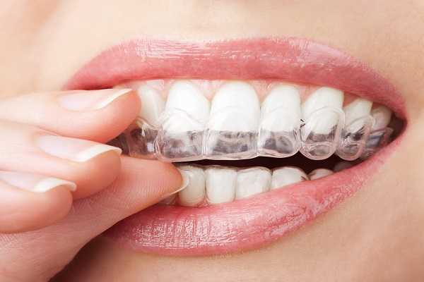 Benefits of Invisalign as an Alternative to Traditional Braces