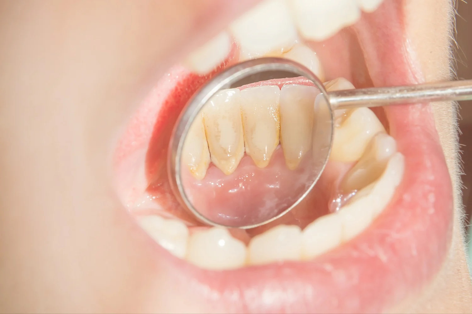 What Is Dental Tartar?